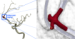 cag-vcbm-aneurysm.png